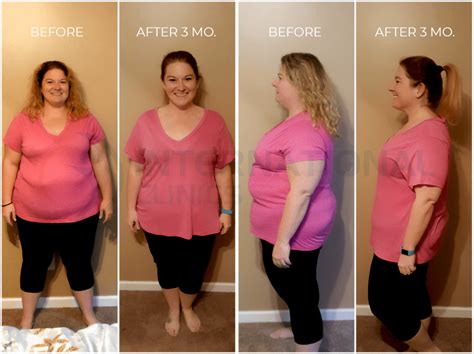 state woman gastric sleeve before and after skin